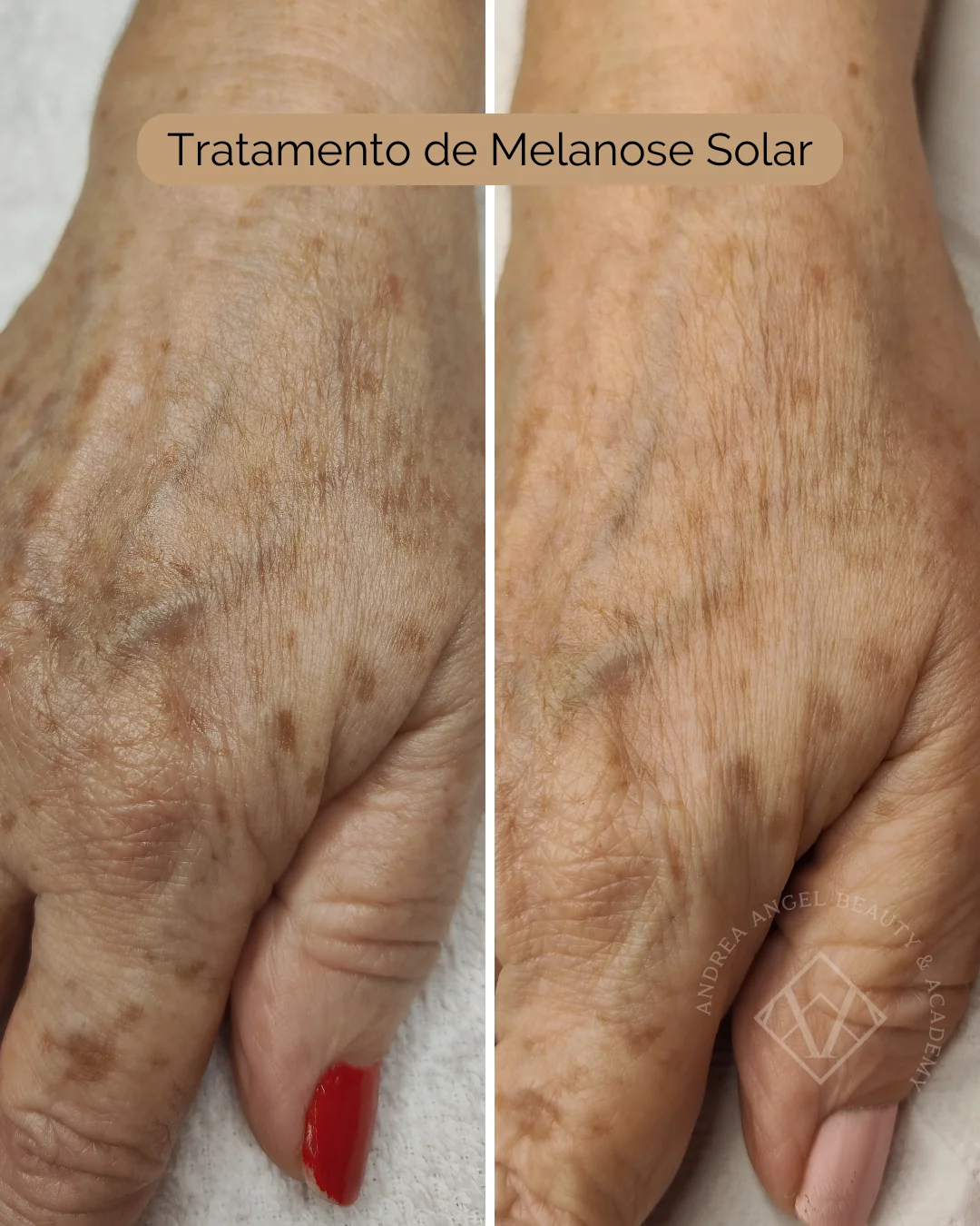 Tratamento melanose solar - rejuvenescimento e clareamento das mãos — comparativo. Portfólio de Andréa Angel.